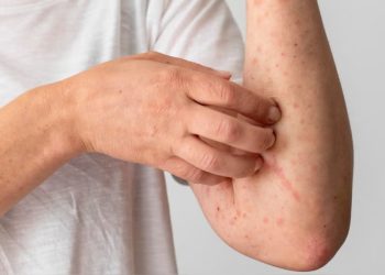 Lepra aún persiste en Loreto, pero hoy tiene cura si se detecta a tiempo