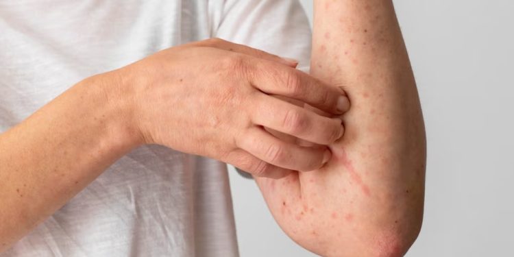 Lepra aún persiste en Loreto, pero hoy tiene cura si se detecta a tiempo