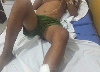 Adolescente mordido por serpiente evoluciona favorablemente en Saramiriza